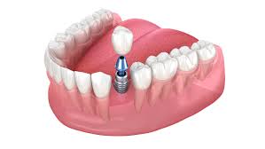 Implantes Dentários